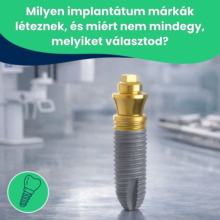 Milyen fogimplantátum márkák léteznek, és miért fontos a választás?